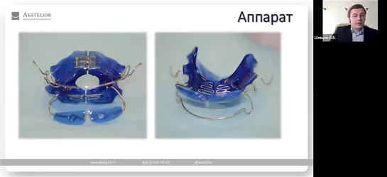 Вебинар. Детское ортодонтическое лечение съемной аппаратурой. Шевцов А.В.