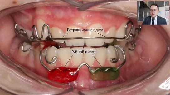 Съёмная ортодонтическая аппаратура, лечение детей и подростков (Часть 1). Вебинар Фролова А. О.