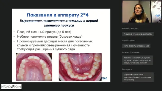 М.Дубовская. Вебинар  ORMCO  "Лечение детей раннего возраста на несъемной аппаратуре"