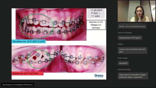 М.Дубовская. Вебинар ORMCO "Ретенция клыков"