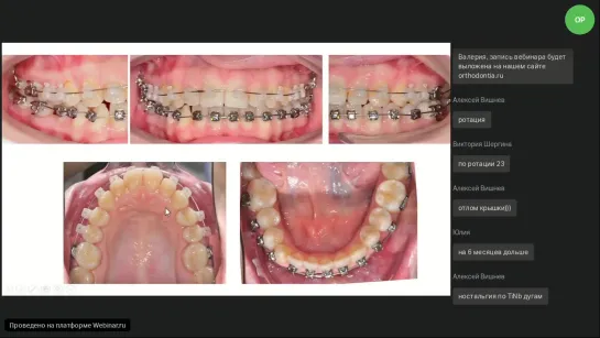 Дмитрий И. Вебинар Ormco  "Больше возможностей для бескомпромиссной эстетики" Ортодонтия