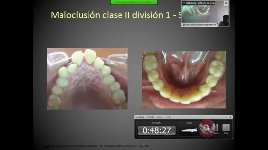 Clasificación de las maloclusiones. Ортодонтия.