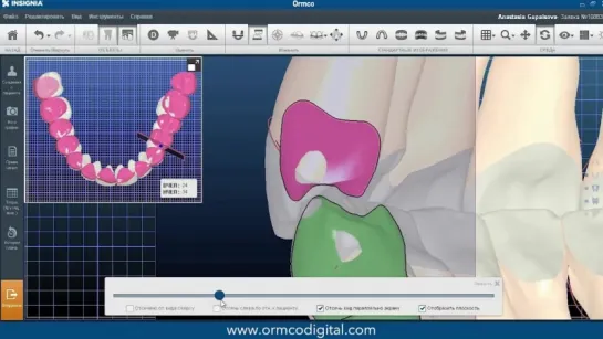 Инструкция по внесению микроизменений при коррекции виртуального сетапа ORMCO. Ортодонтия.