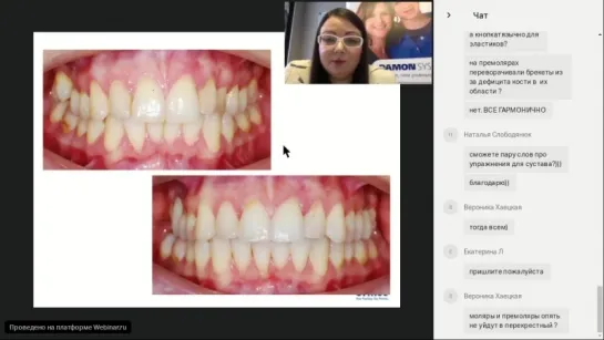 Запись вебинара Ormco - А.Бадмаевой "Ортодонтическое лечение у пациентов с протезированием зубов"