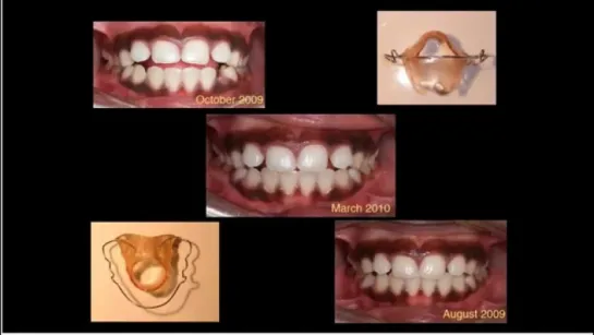 Часть семинара Жан Рене Ван Беселер ORMCO. Ортодонтия.