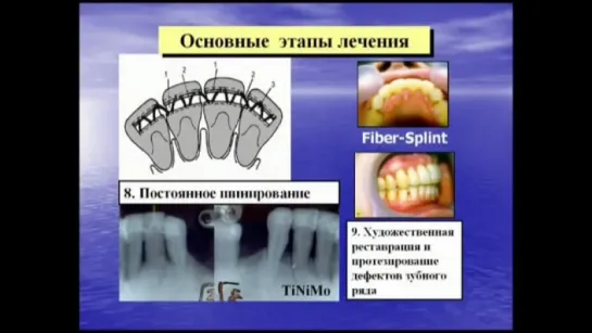 Проблемное зубочелюстное протезирование. Роль ортодонта. Учебное видео.