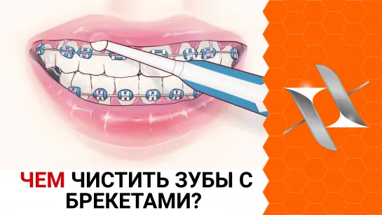 ЧЕМ ЧИСТИТЬ ЗУБЫ С БРЕКЕТАМИ | Где купить? Что выбрать? (гигиена, стоматология)