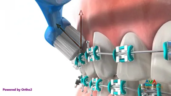 Life with Braces. Ортодонтия.Гигиена.