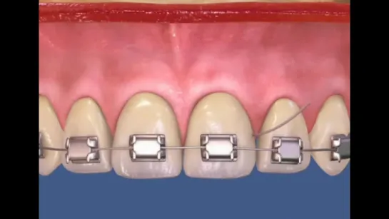 Использование флосса при лечении на брекетах. Гигиена. Ортодонтия.