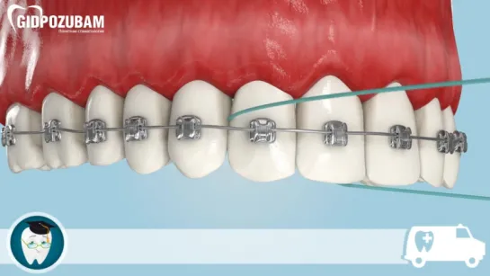 Флосс. Как правильно пользоваться зубной нитью при брекетах. Гигиена. Ортодонтия.