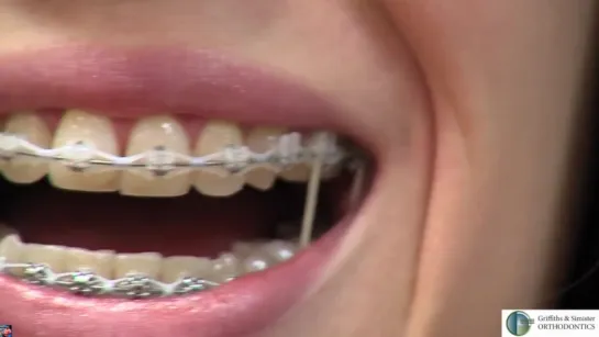 Our New Hygiene Video!! How to take care of Your Braces! Гигиена в ортодонтии.