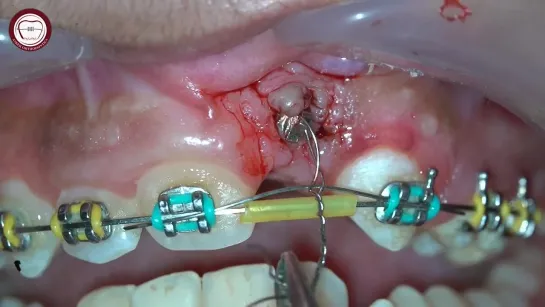 impacted teeth traction in orthodontics, apical reposition flap with double wire