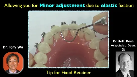 Chris Chang Ortho  Tip for Fixed Retainer