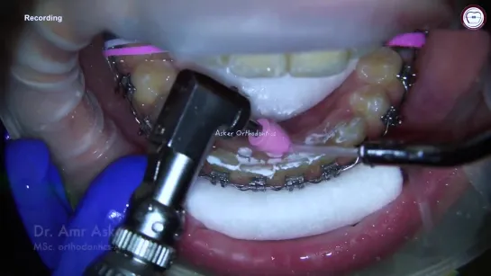 fixed permanent retainer bonding in orthodontics by dr. Amr asker. Фиксация ретейнера. Ортодонтия