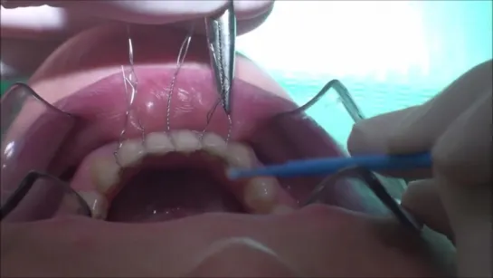 LINGUAL FIXED RETAINERS IN CLINICAL ROUTINE - DIRECT TECHNIQUE C METALLIC TIES. Ортодонтия.