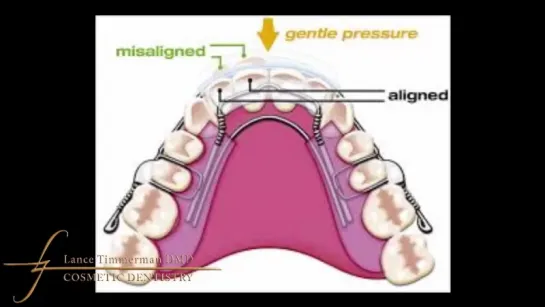 Can orthodontic retainers straighten teeth. Ортодонтия.