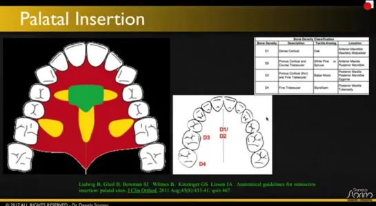 Dental Treatment Accelerated Orthodontics Jan 2018. Ортодонтия.