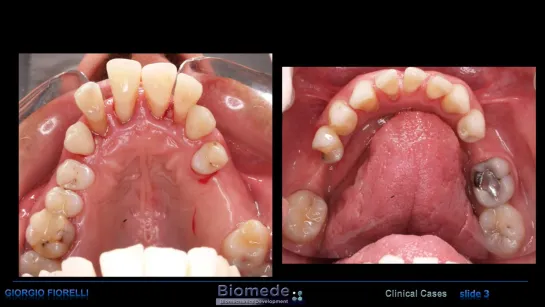 Orthodontic treatment of a severe perio case. Ортодонтия.