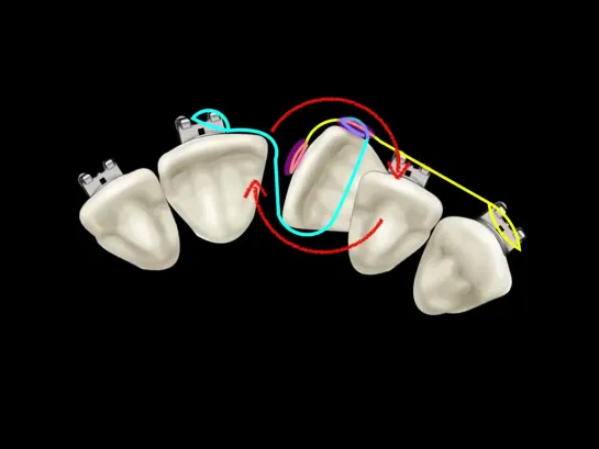 A Case of a Rotated Central Incisor. Ортодонтия.