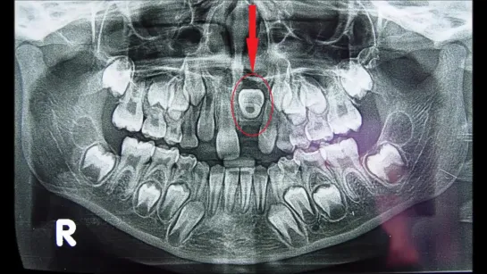 Orthodontic Treatment of an Impacted Dilacerated Upper Central Incisor. Ортодонтия.