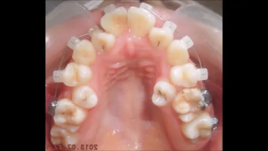 Информационный ролик с клиническим случаем. Ортодонтия. Япония.