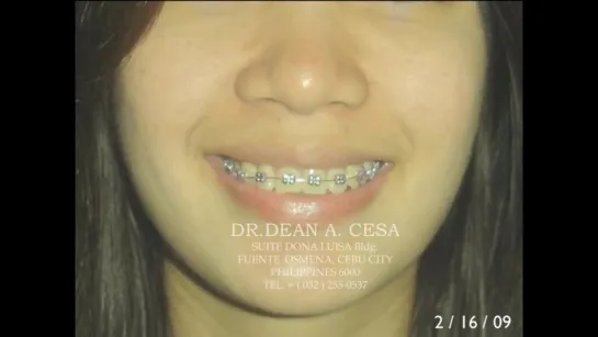 ORTHODONTIC TREATMENT 10 BY DR. DEAN A. CESA. Ортодонтия.