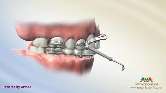 Orthodontic Expander or Spacer - Crossbow Appliance. Ортодонтия.