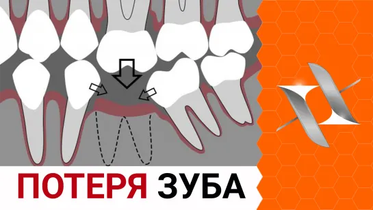 Потеря зуба | Что делать если зубы наклонились? Помогут ли брекеты? (стоматология)