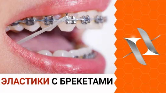 ЭЛАСТИКИ (тяги) и брекеты | Для чего? Как с ними жить? (Брекеты, стоматология)