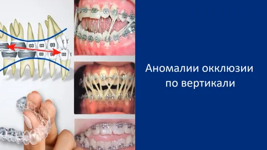 Аномалии окклюзии по вертикали. Пропедевтика ортодонтии. МГМСУ. Стоматология.