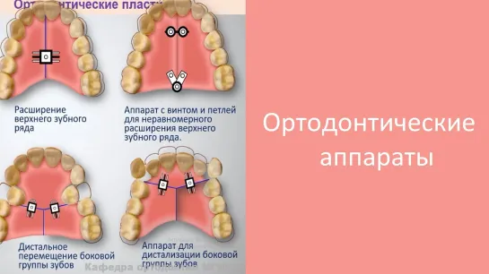 Ортодонтические аппараты. Пропедевтика ортодонтии. МГМСУ. Стоматология