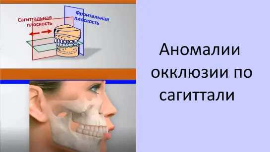 Аномалии окклюзии по сагиттали. Пропедевтика МГМСУ. Стоматология