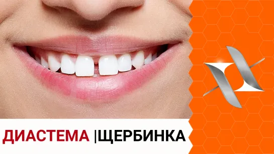 ДИАСТЕМА/щербинка | Почему возникает, как убрать и можно ли оставить? (Брекеты, стоматология)