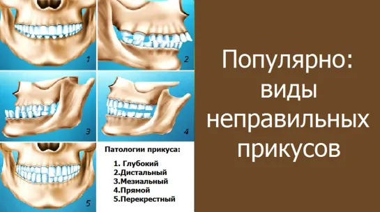 Популярно: виды неправильных прикусов. Ортодонтия. Стоматология.