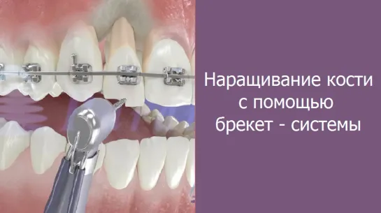 Популярно: наращивание кости с помощи брекет - системы. Экструзия. Ортодонтия. Стоматология