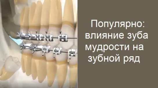 Наглядно о том, почему иногда следует удалить зубы мудрости до установки брекет-системы. Ортодонтия, стоматология.