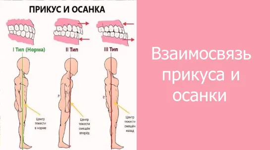 Взаимосвязь прикуса и осанки. Ортодонтия, гнатология.