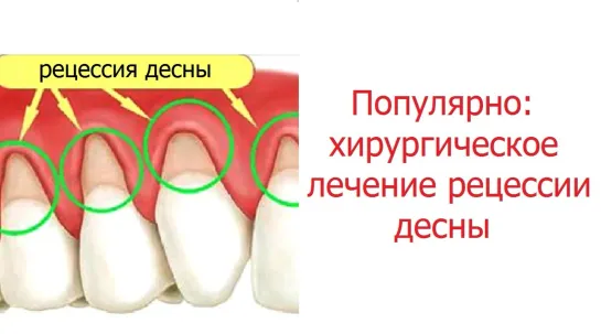 Популярно: рецессия десны лечение. Стоматология. Пародонтология.