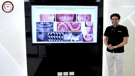 Orthodontic cases series by dr. Amr Asker impacted teeth traction in orthodontics