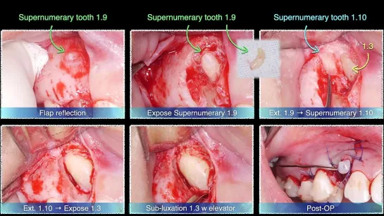 Chris Chang Ortho . U3 Impaction：Aligner tx + 3D lever arm