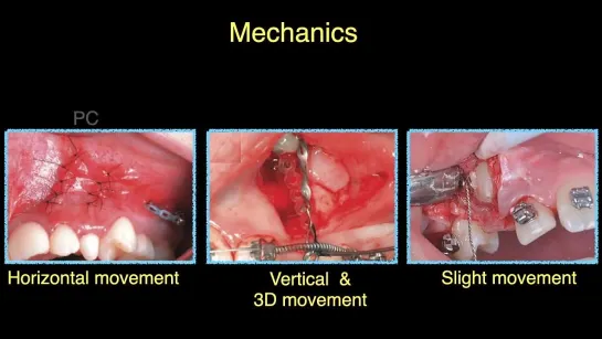 Chris Chang Ortho.  The thinking process of surgical exposure of canine impaction