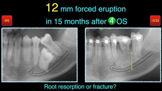 Chris Chang Ortho  Management of ankylosed molars