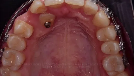 Surgical  orthodontic insertion of the canine into the arch