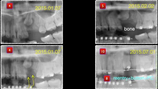 Orthodontic and surgical treatment of deep bite, congenital missing premolar and high impacted canin Ортодонтия