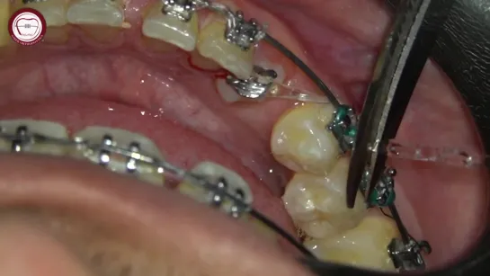 Step by step orthodontic archwire insertion for rotated canine traction by Dr. Amr Asker. Ортодонтия