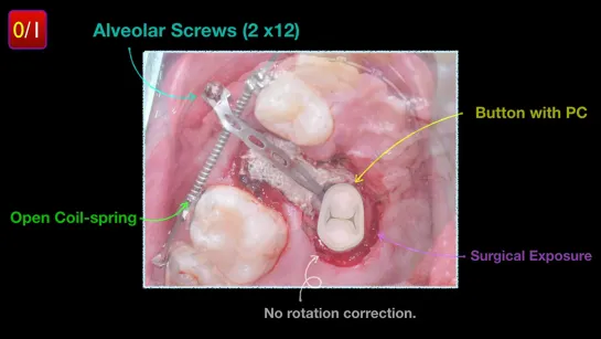 Chris Chang Ortho  Simple Solution for the Palatally Impacted Upper 2nd Premolar