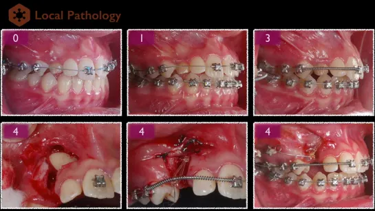 Etiology of Maxillary Canine Impaction by Dr. Kim Lin. Ортодонтия