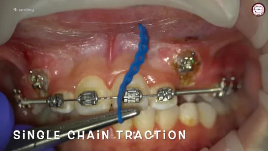 Exposure and traction of labial impacted canines, traction by power chain, Amr Asker. Ортодонтия