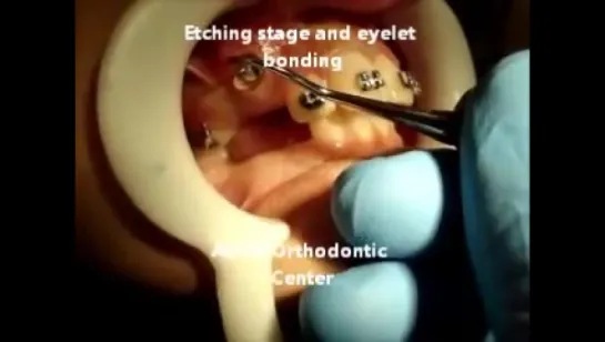 Canine exposure with diathermy (electrocautary) and orthodontic traction by Dr.Amr Asker. Ортодонтия.