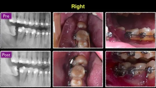 Align impacted 3rd molars with molar tubes and CuNiTi archwires.  Ортодонтия